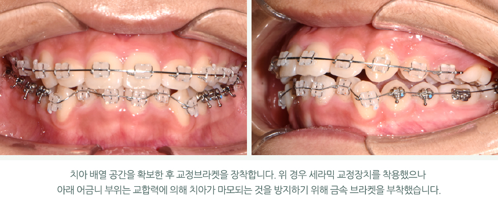 치아 배열 공간을 확보한 후 교정브라켓을 장착합니다. 위 경우 세라믹 교정장치를 착용했으나 아래 어금니 부위는 교합력에 의해 치아가 마모되는 것을 방지하기 위해 금속 브라켓을 부착했습니다.