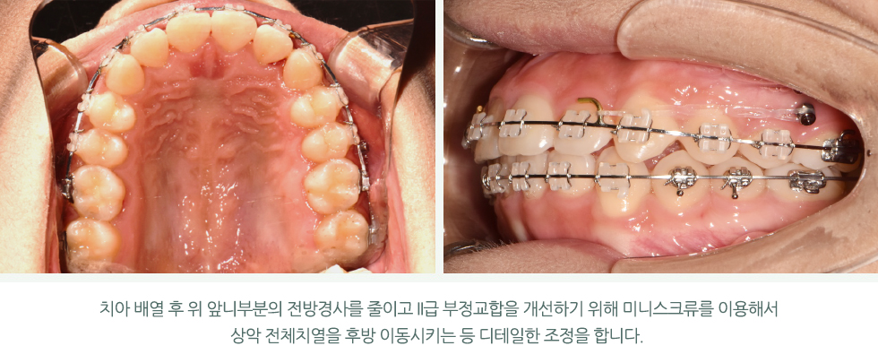 치아 배열 후 위 앞니부분의 전방경사를 줄이고 2급 부정교합을 개선하기 위해 미니스크류를 이용해서 상악 전체치열을 후방 이동시키는 등 디테일한 조정을 합니다.