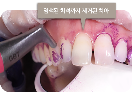 염색된 치석까지 제거된 치아