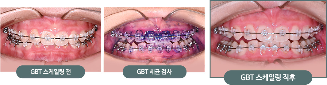 GBT 스케일링 전 > GBT 세균 검사 > GBT 스케일링 직후